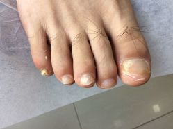 -德哥灰指甲脚气甲沟炎跖疣护理