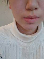 体验后-颜蕾医美黄金微针水光美肤玻尿酸抗衰中心