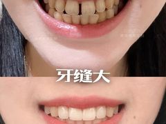 -上海仁爱医院口腔科 · 种植