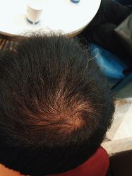 -碧莲盛·不剃发植发