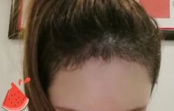 -大麦微针植发丨全国连锁