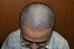 点击看大图 -大麦微针植发丨全国连锁