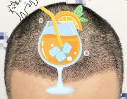 -大麦微针植发全国连锁