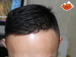 -大麦微针植发丨全国连锁