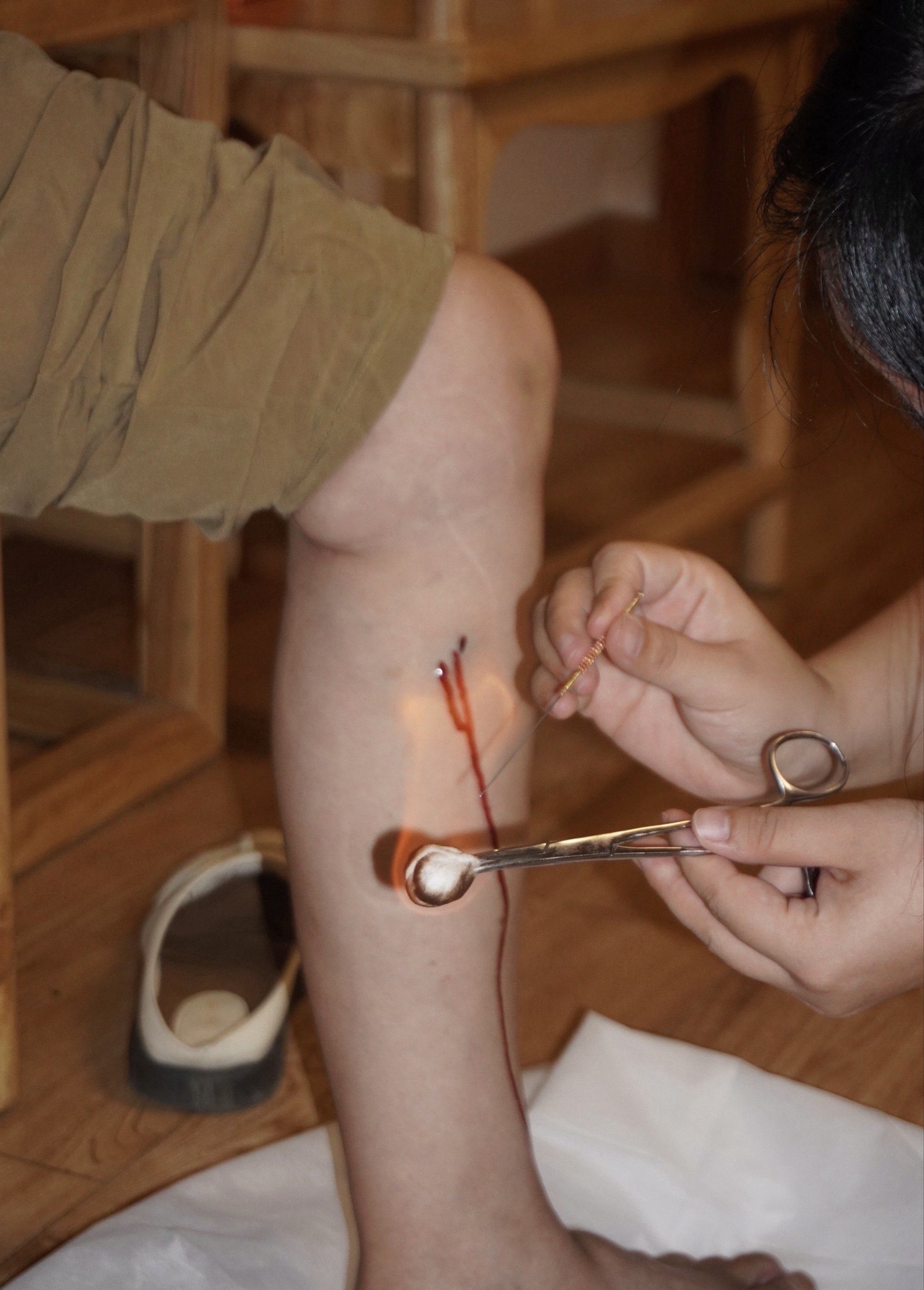 南昌这个中医针灸很厉害 火针治老寒腿疼很有用