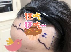 -大麦微针植发全国连锁