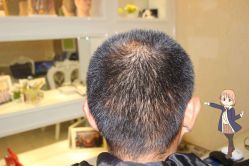 -大麦微针植发丨全国连锁