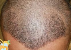 -大麦微针植发丨全国连锁