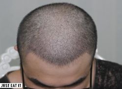 -大麦微针植发丨全国连锁