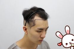 -大麦微针植发丨全国连锁