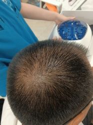 -碧莲盛·不剃发植发