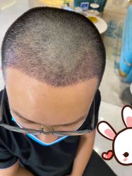 点击看大图 -大麦微针植发丨全国连锁