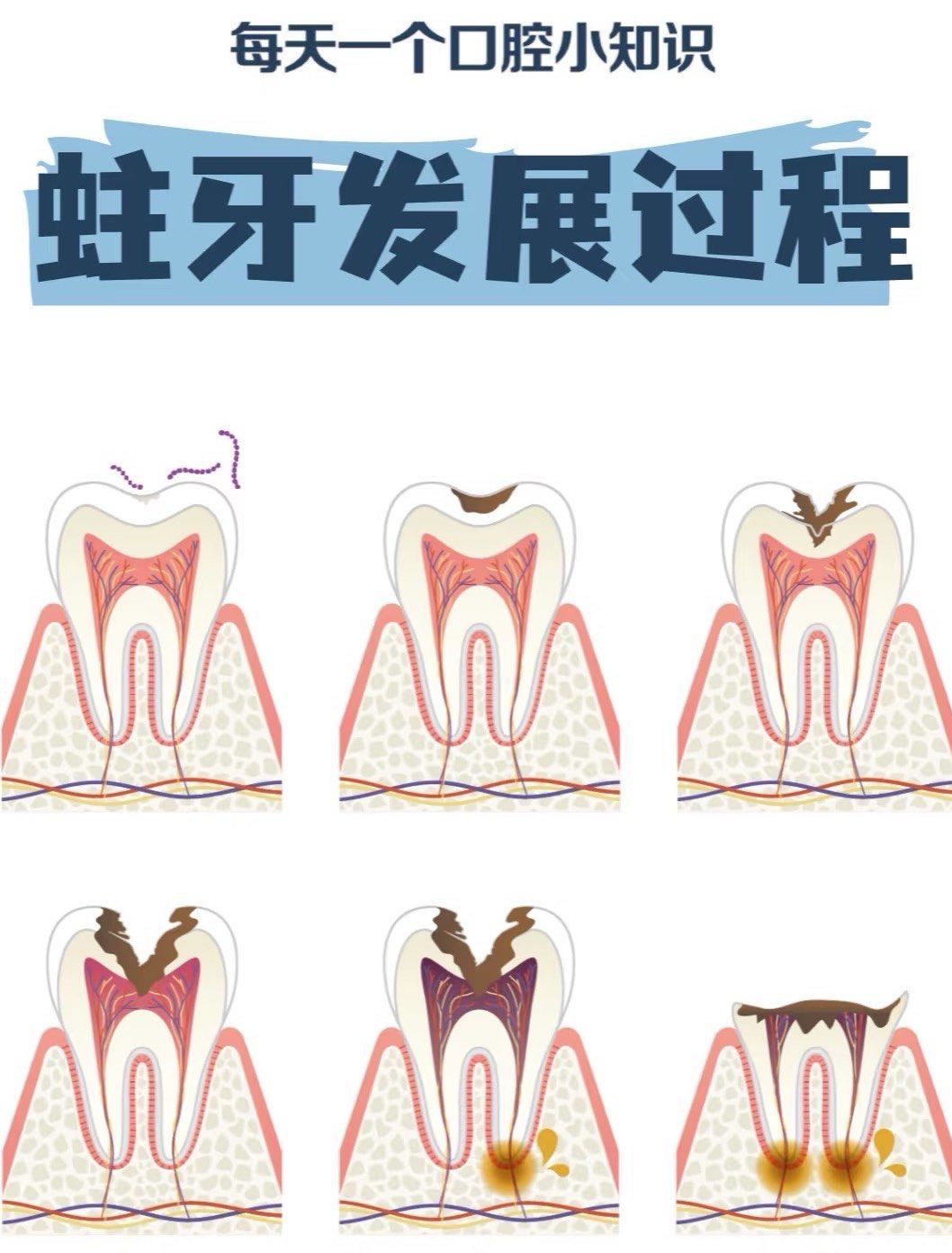 牙釉质表面会出现脱矿,形成白垩色的斑点 ,这些斑点此时没有明显的