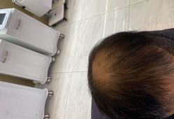 点击看大图 -大麦微针植发丨全国连锁