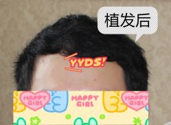 -大麦微针植发全国连锁