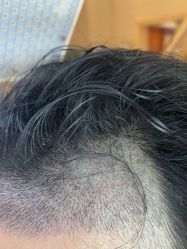 -碧莲盛·不剃发植发