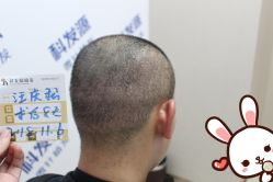 -大麦微针植发丨全国连锁