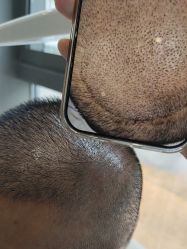 -碧莲盛·不剃发植发