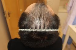 -大麦微针植发丨全国连锁