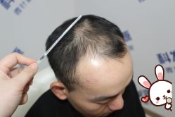 -大麦微针植发丨全国连锁