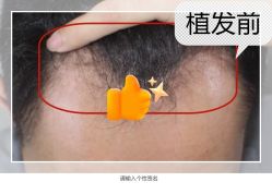 -大麦微针植发全国连锁