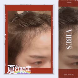 -大麦微针植发全国连锁