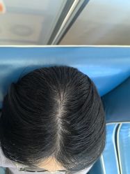 -大麦微针植发全国连锁