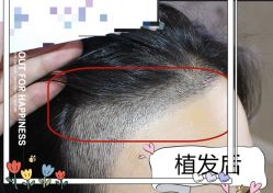 -大麦微针植发全国连锁