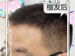-大麦微针植发全国连锁