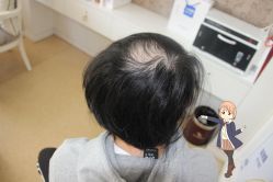 -大麦微针植发丨全国连锁