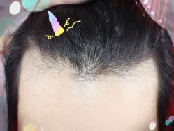 -大麦微针植发全国连锁