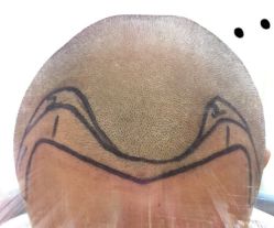 -大麦微针植发全国连锁