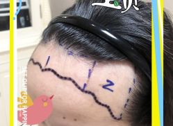 -大麦微针植发全国连锁