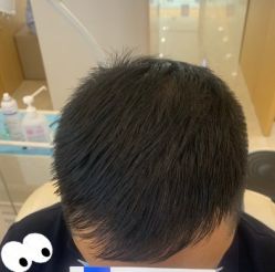 -大麦微针植发丨全国连锁