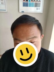 点击看大图 -大麦微针植发丨全国连锁