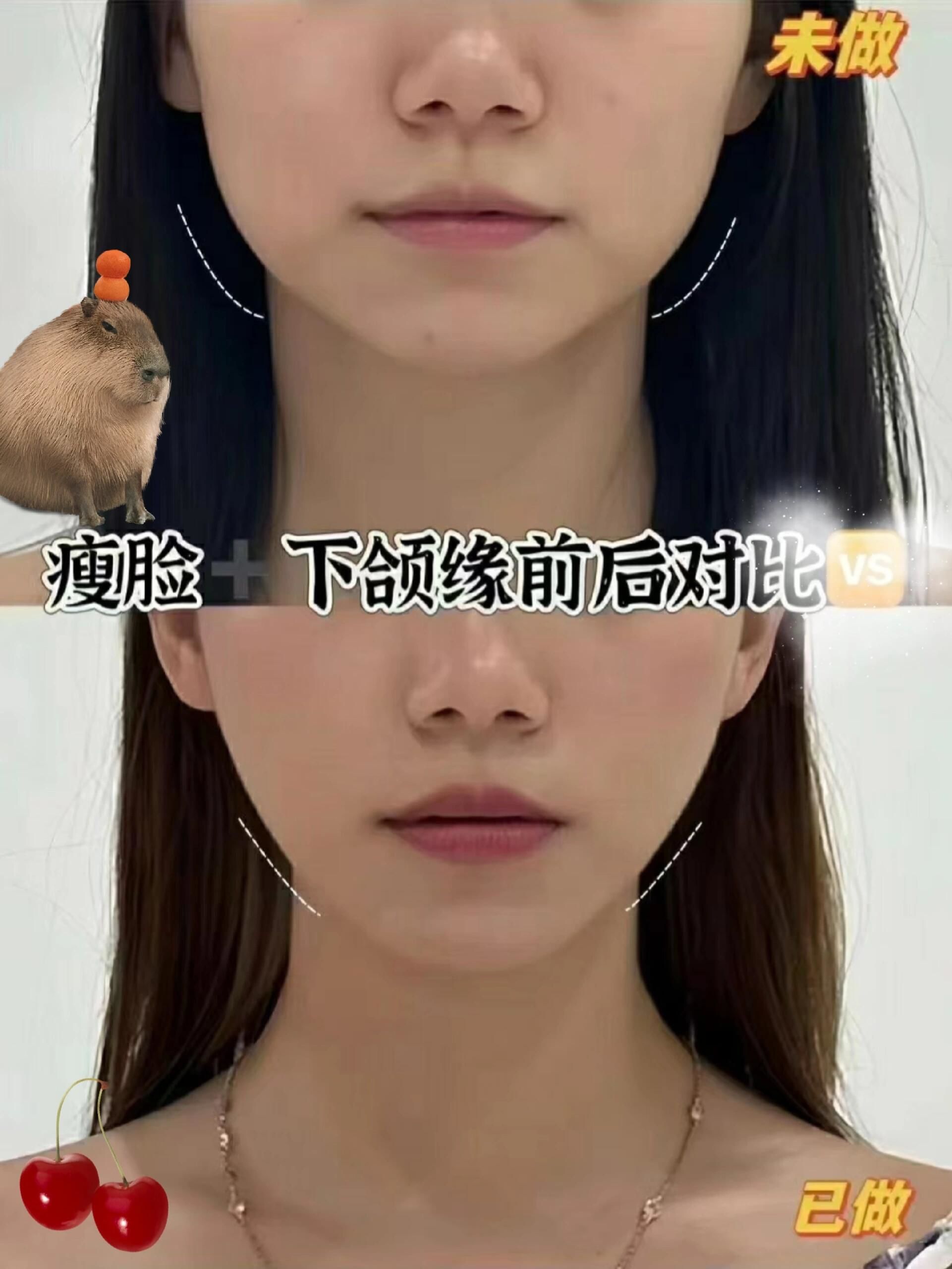 瘦脸针记录