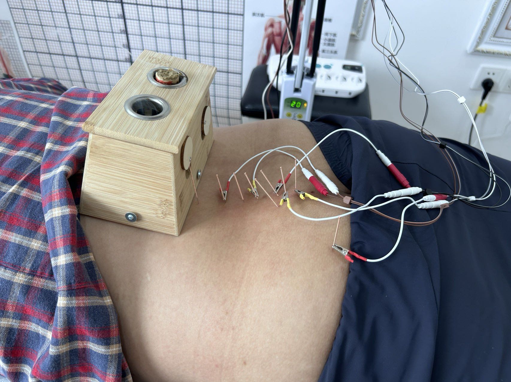 急性腰扭伤
