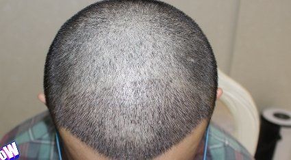 -大麦微针植发丨全国连锁