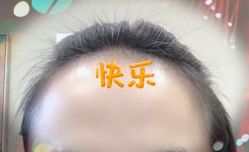 -大麦微针植发全国连锁