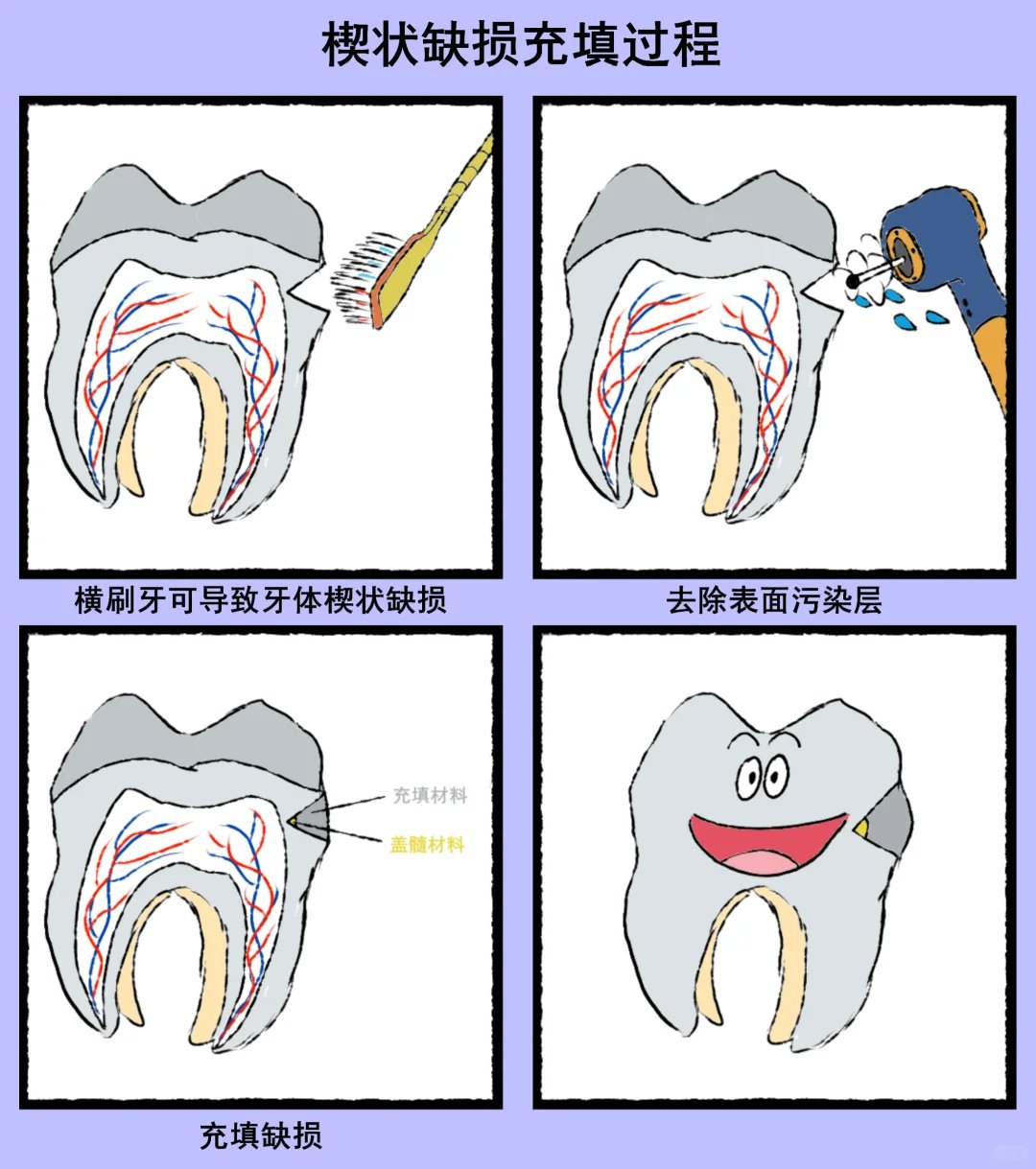 楔状缺损怎么治疗图片