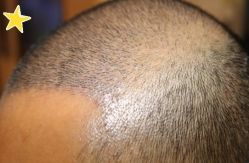 -大麦微针植发丨全国连锁