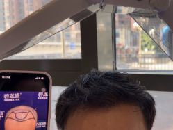 -碧莲盛·不剃发植发