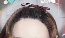 -大麦微针植发全国连锁