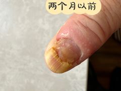 -祖传修脚甲沟炎灰指甲鸡眼