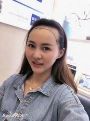 -大麦微针植发丨全国连锁