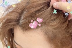 -大麦微针植发全国连锁