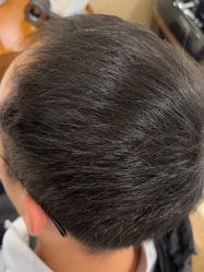 -碧莲盛·不剃发植发