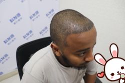 -大麦微针植发丨全国连锁