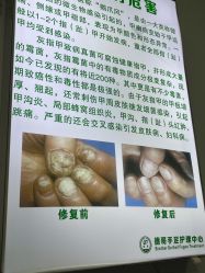 -德哥灰指甲脚气甲沟炎跖疣护理