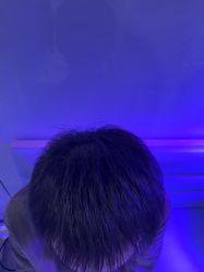 -大麦微针植发丨全国连锁